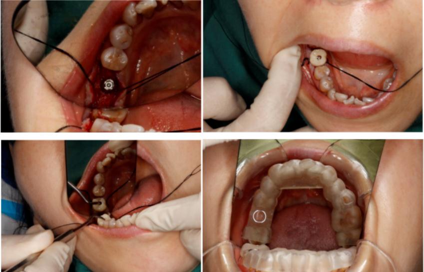 ng28南宫与精瓷义齿共创齿科3D打印医疗新未来