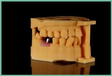 “以科技破局,以数字化赋能”——ng28南宫与精瓷义齿共创齿科3D打印医疗新未来04 “以科技破局,以数字化赋能”——ng28南宫与精瓷义齿共创齿科3D打印医疗新未来04